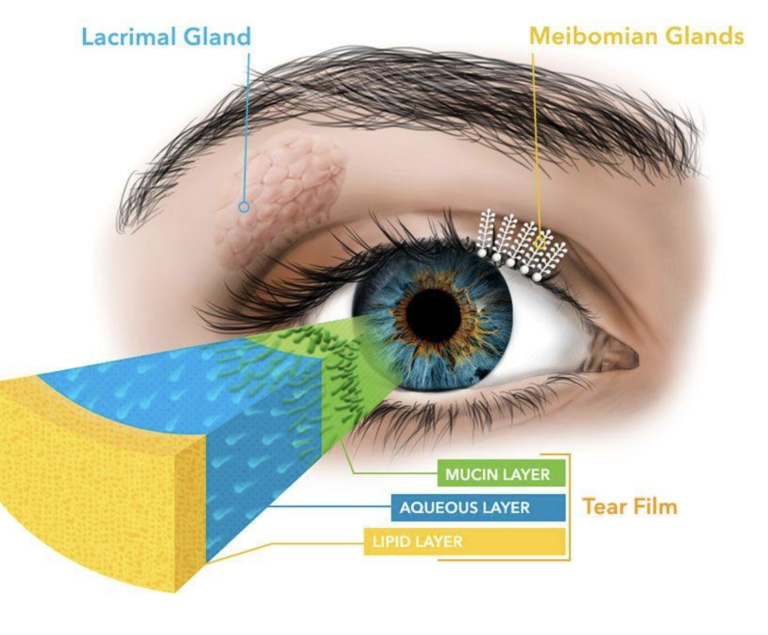 Meibomian Gland Dysfunction MGD Treatment In Bellevue WA meibomian-gland-dysfunction-mgd-treatment-in-bellevue-wa